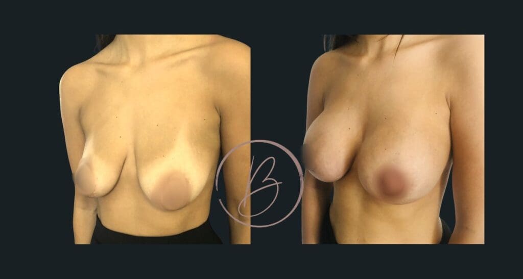 Augmentation mammaire – résultat avant/après à 3 mois, Dr Djazia Benyahi, chirurgien esthétique à Paris