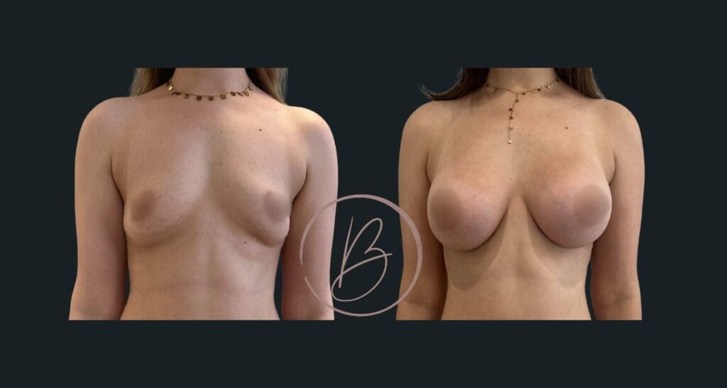 Augmentation mammaire par prothèses – résultat avant/après à 3 mois, Dr Djazia Benyahi, chirurgien esthétique à Paris