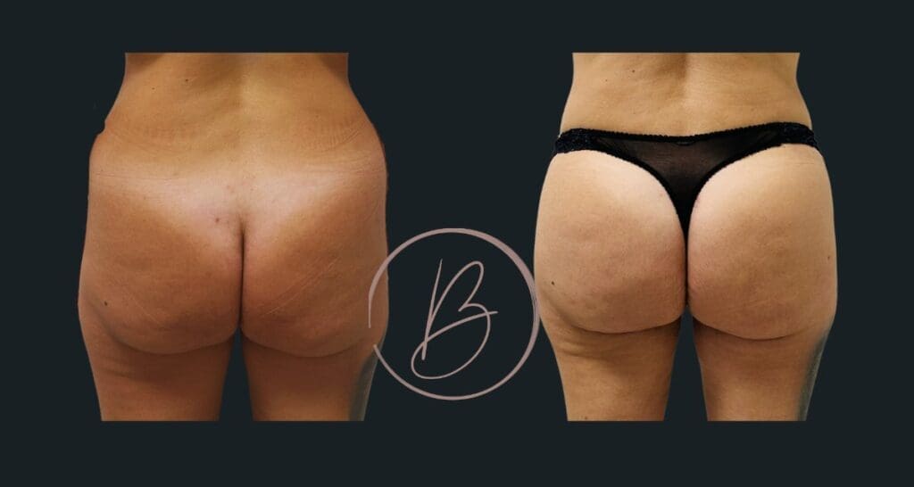 BBL (lipofilling fessier) - résultat avant/après à 3 mois, Dr Djazia Benyahi, chirurgien esthétique à Paris