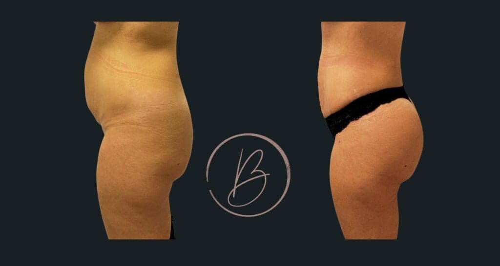 BBL (lipofilling fessier) - résultat avant/après à 3 mois, Dr Djazia Benyahi, chirurgien esthétique à Paris