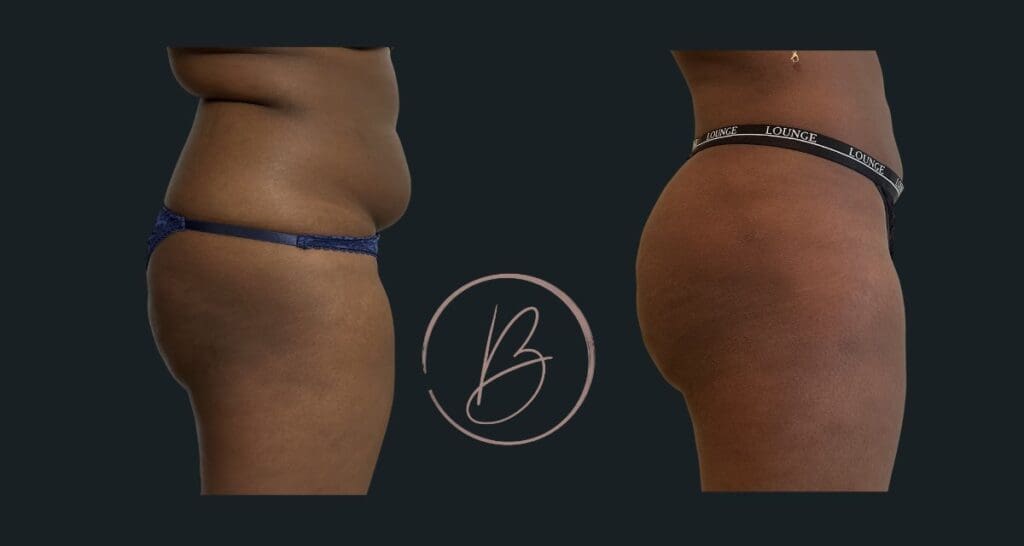 BBL (lipofilling fessier) - résultat avant/après à 3 mois, Dr Djazia Benyahi, chirurgien esthétique à Paris