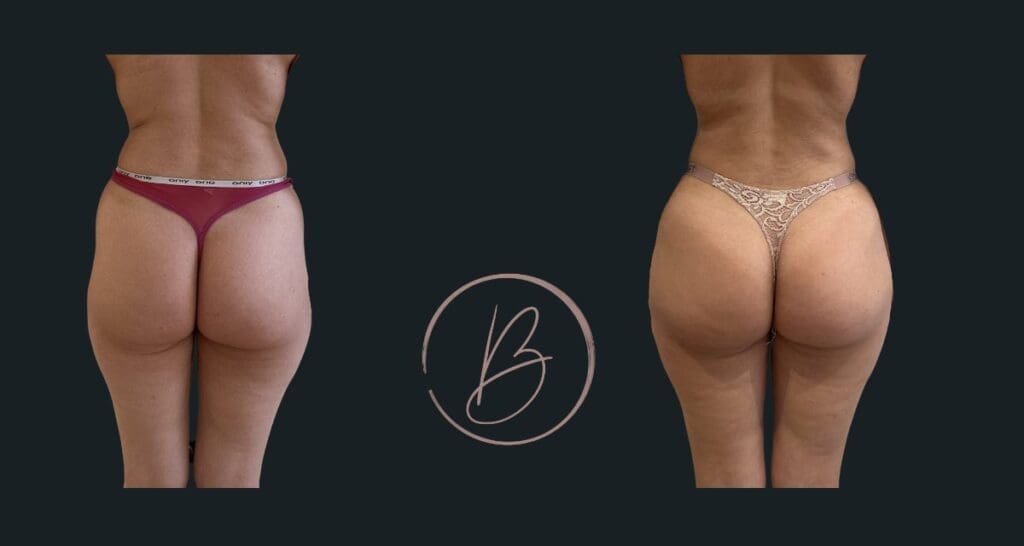 BBL (lipofilling fessier) - résultat avant/après à 3 mois, Dr Djazia Benyahi, chirurgien esthétique à Paris