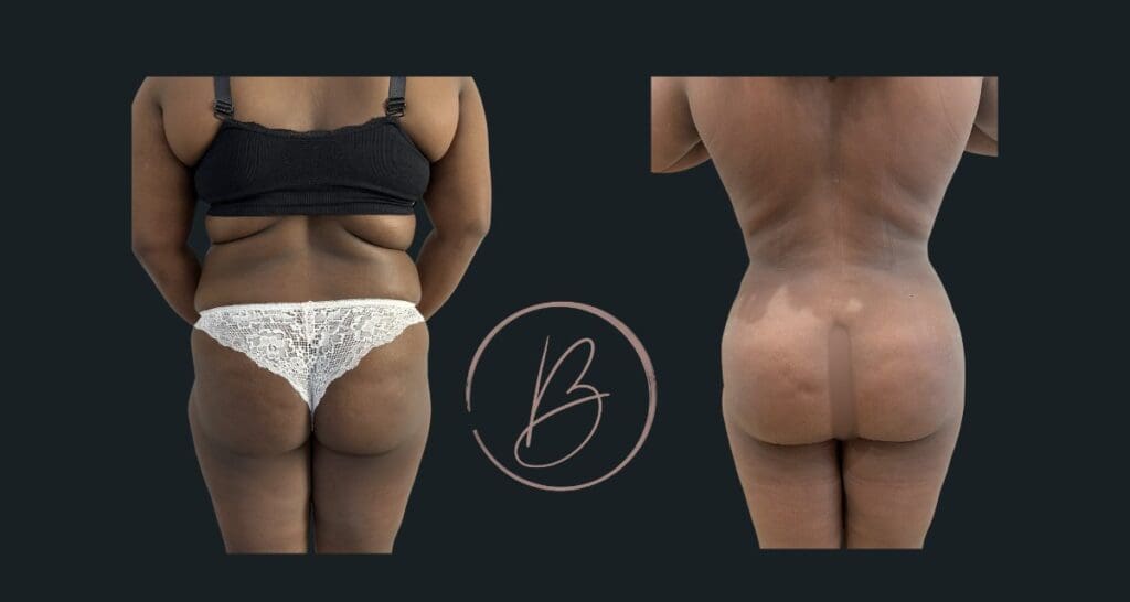 BBL (lipofilling fessier) - résultat avant/après à 3 mois, Dr Djazia Benyahi, chirurgien esthétique à Paris