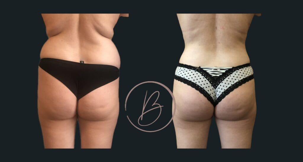 Lipoaspiration - résultat avant/après à 3 mois, Dr Djazia Benyahi, chirurgien esthétique à Paris
