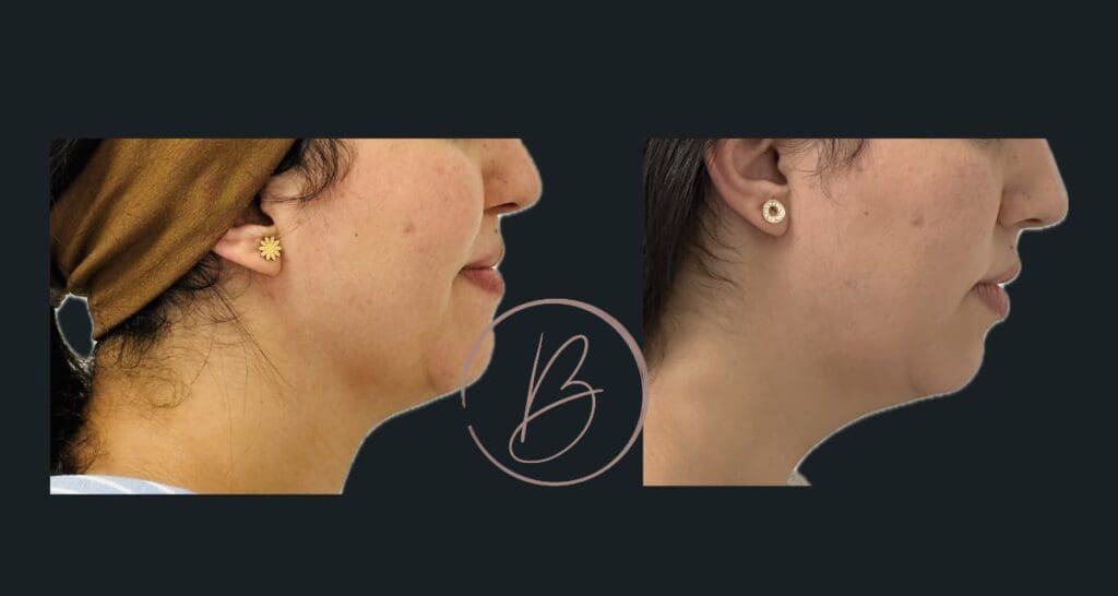 Lipoaspiration - résultat avant/après à 3 mois, Dr Djazia Benyahi, chirurgien esthétique à Paris