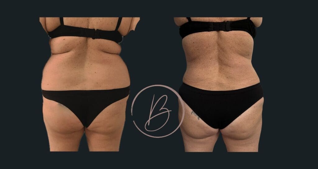 Lipoaspiration - résultat avant/après à 3 mois, Dr Djazia Benyahi, chirurgien esthétique à Paris
