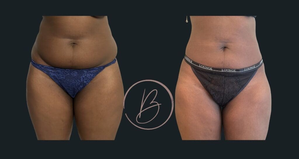 Lipoaspiration - résultat avant/après à 3 mois, Dr Djazia Benyahi, chirurgien esthétique à Paris
