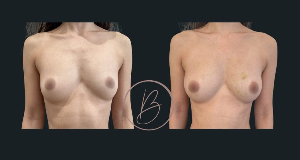 Lipofilling mammaire - résultat avant/après à 3 mois, Dr Djazia Benyahi, chirurgien esthétique à Paris