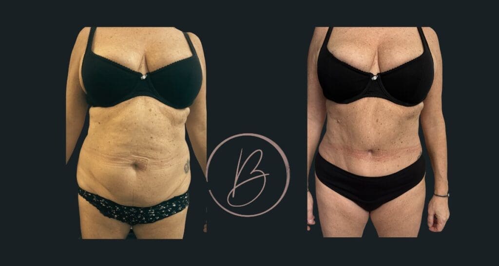 Plastie abdominale (abdominoplastie) - résultat avant/après à 3 mois, Dr Djazia Benyahi, chirurgien esthétique à Paris