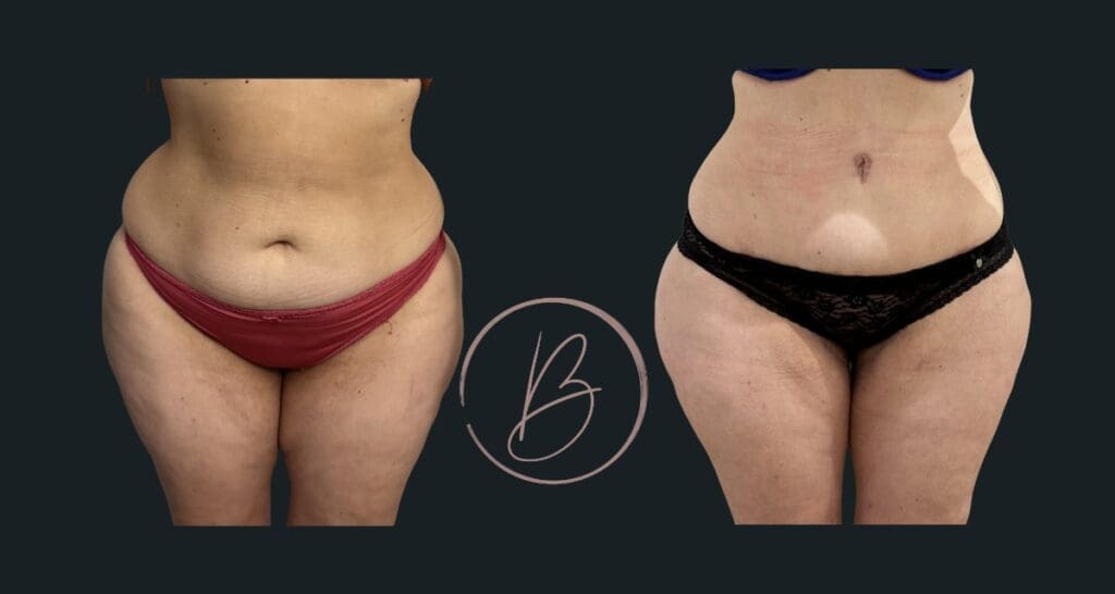 Plastie abdominale (abdominoplastie) - résultat avant/après à 3 mois, Dr Djazia Benyahi, chirurgien esthétique à Paris