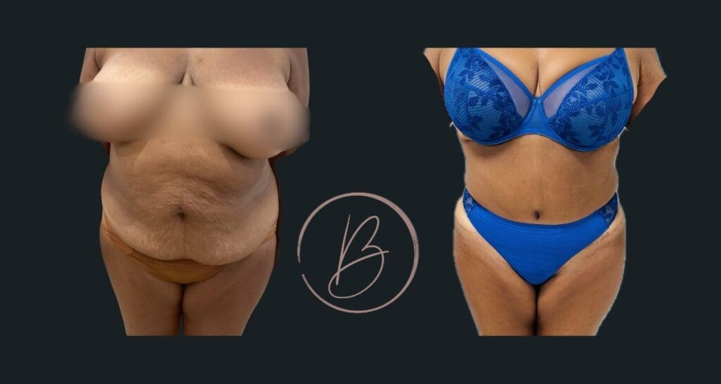 Plastie abdominale (abdominoplastie) - résultat avant/après à 3 mois, Dr Djazia Benyahi, chirurgien esthétique à Paris