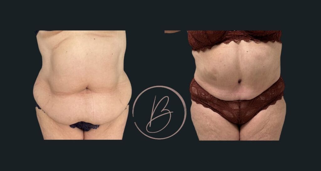 Plastie abdominale (abdominoplastie) - résultat avant/après à 3 mois, Dr Djazia Benyahi, chirurgien esthétique à Paris